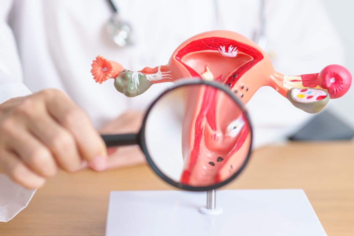 Fatores de risco da endometriose